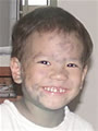 chickenpox