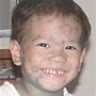 chickenpox